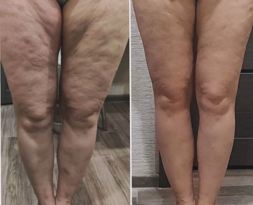 Masaj pentru pierderea în greutate