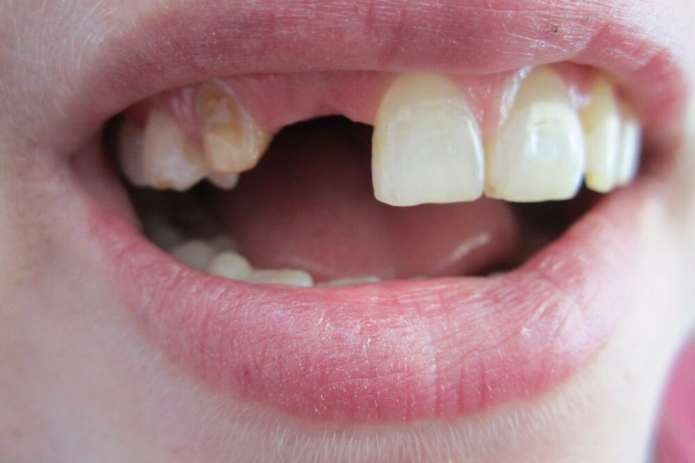 Зубные протезы    с
