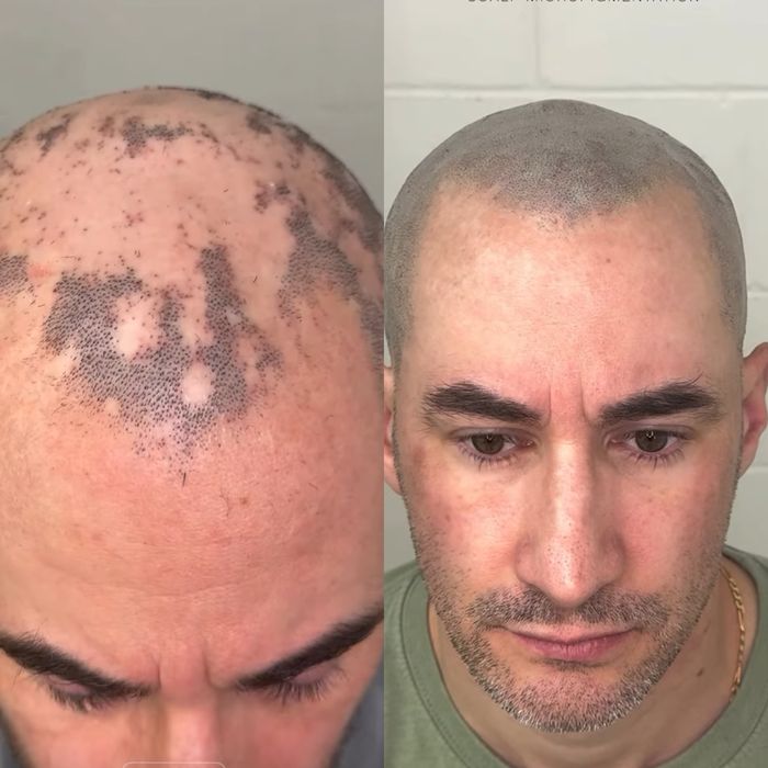 Micropigmentare Scalp și barba Bucuresti SMP chelie implant transplant