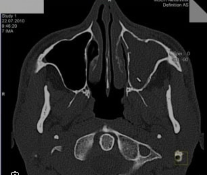 Мскт носа придаточные пазухи