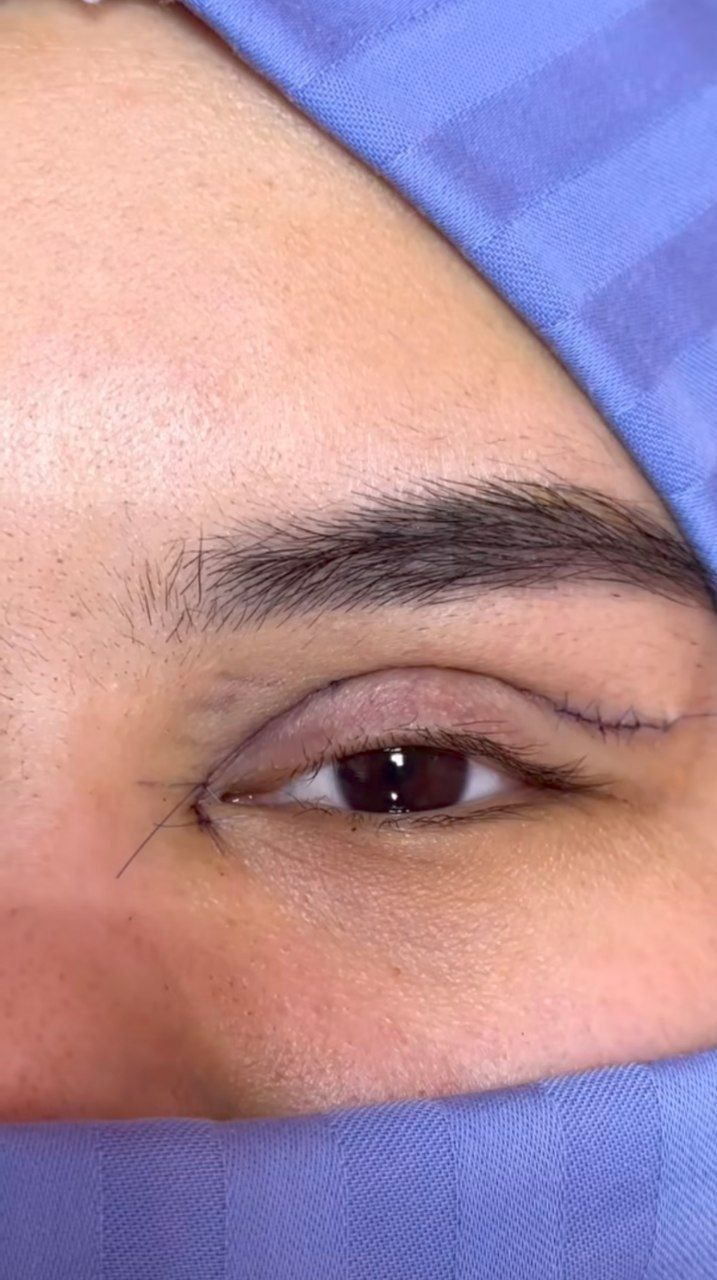SKIDKADA Blefaraplastika, Nitevoy Sangapuri, browlifting