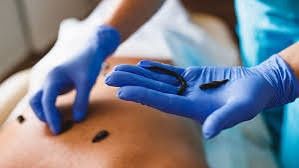 Zuluk va hijama xizmati