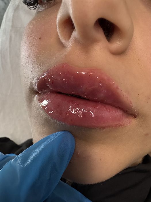 Augmentare buze,menton,riduri