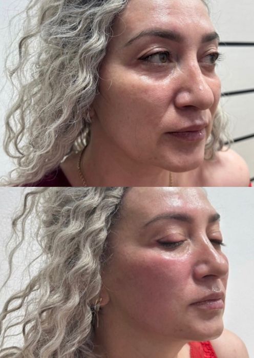 Микроигольчатый RF-лифтинг