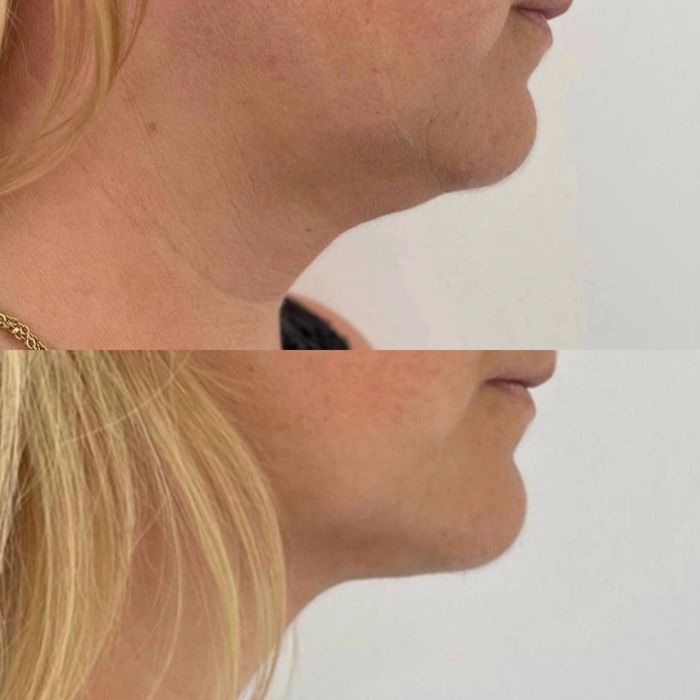 Чистка,  пилинг, мезотерапия, ботокс