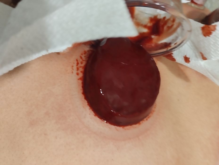 Хиджама хиджама ..