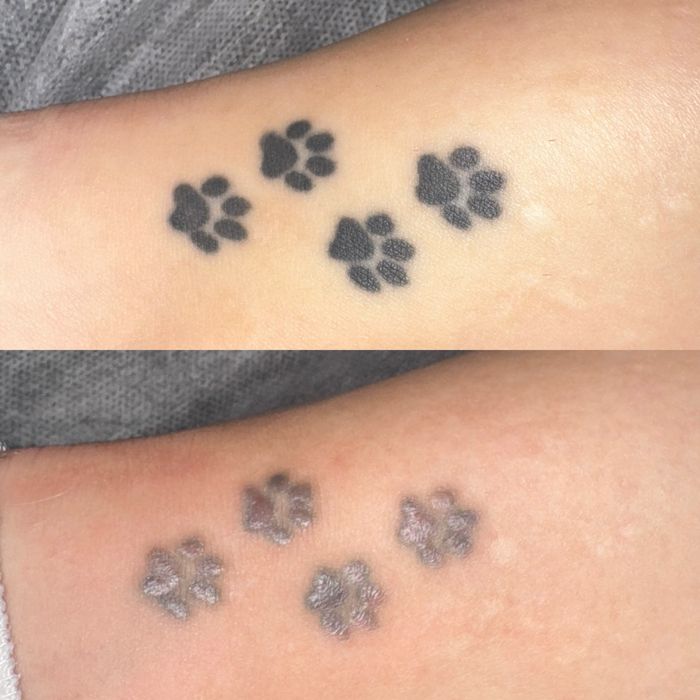 Stergere tatuaje cu laser nd:Yag