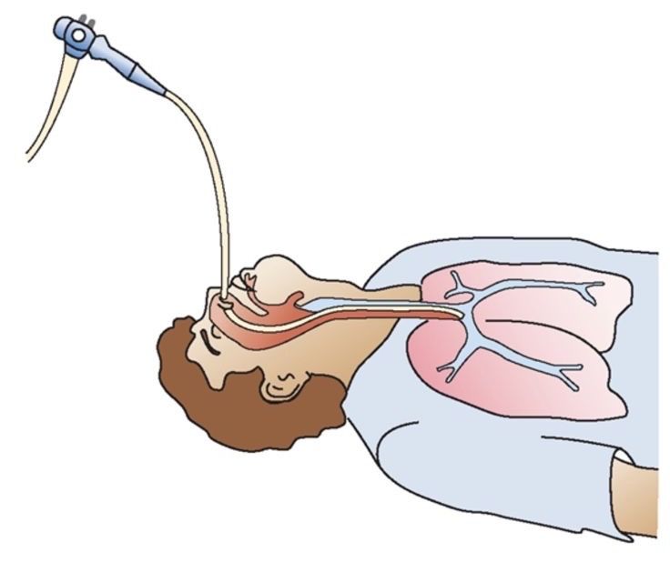 Санация дыхательных путей