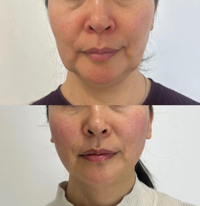 Микроигольчатый RF-лифтинг