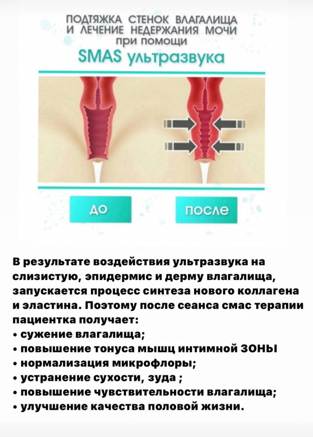 Ультразвуковое интимное омоложение