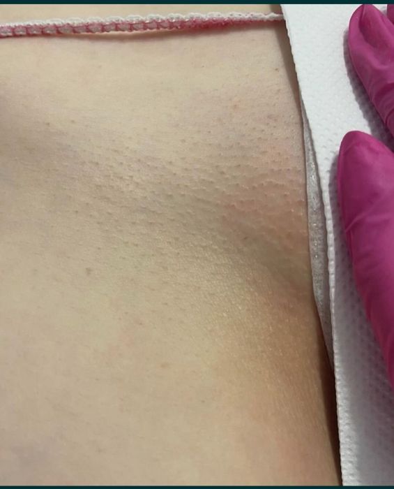 Epilare definitiva Sector 2