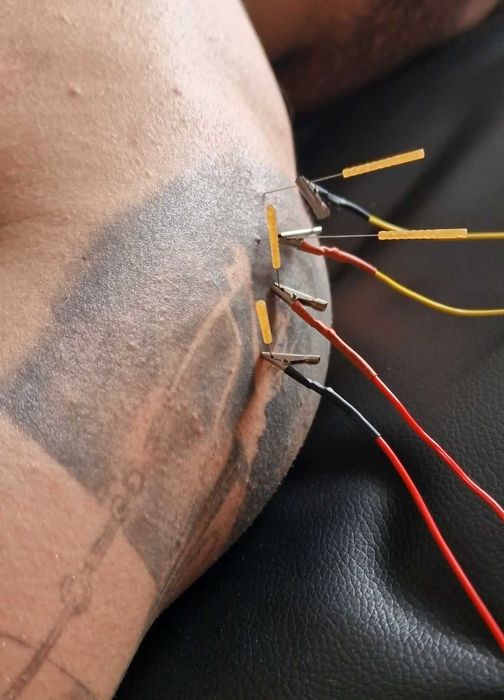 Kinetoterapie & Recuperare | Dry Needling, Tecar, Masaj Terapeutic