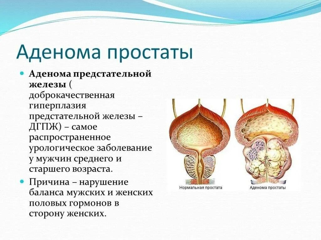 Урологиялық емдік массаж. Гемарройды операциясыз емдеу.