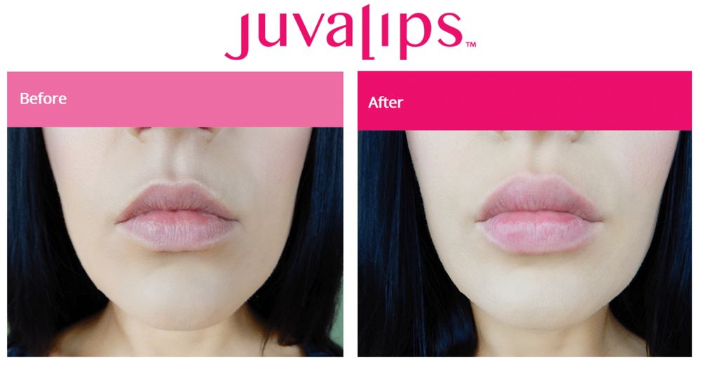 Juvalips lip plumper