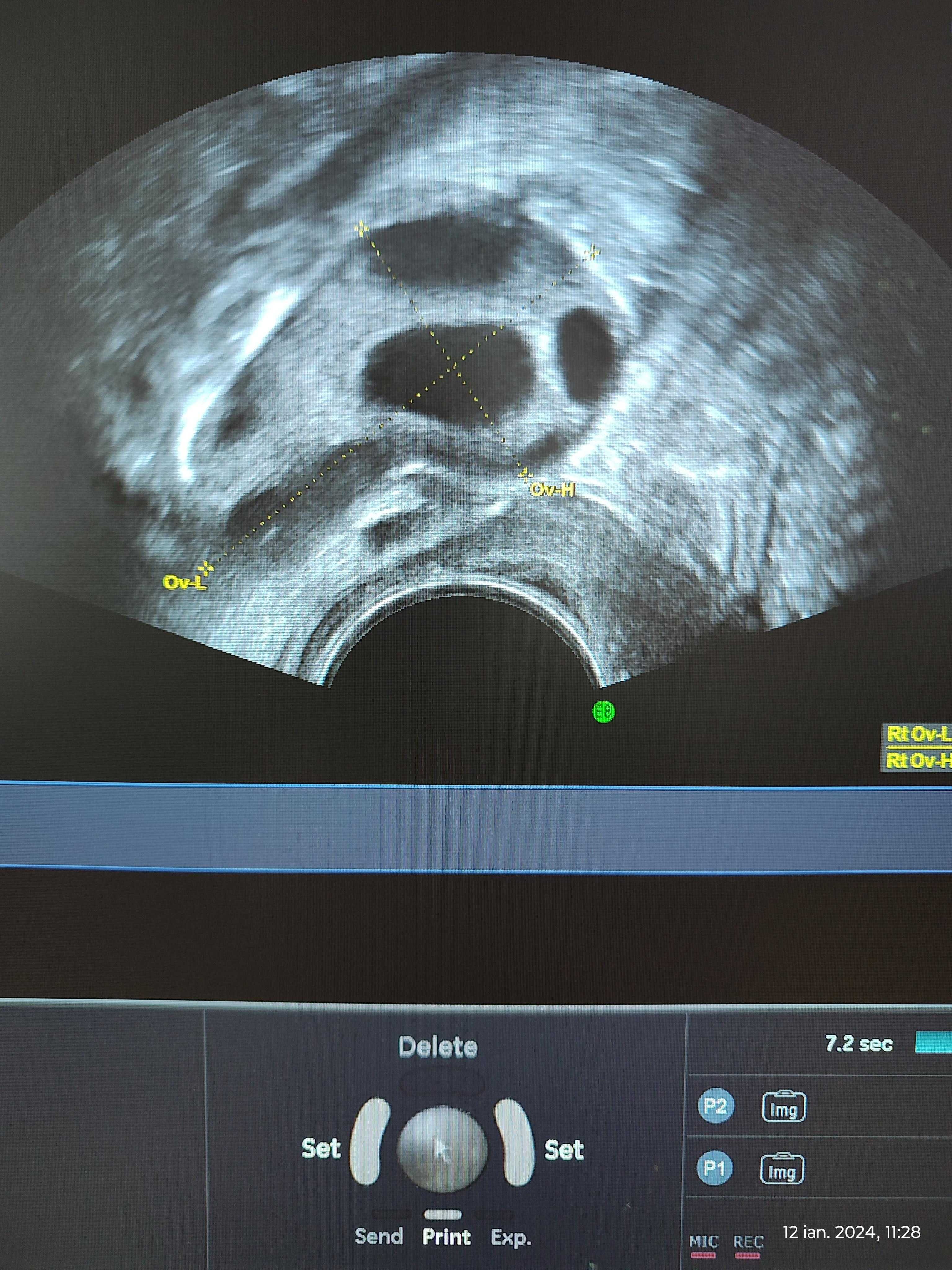 Ecograf doppler Voluson E8 Expert