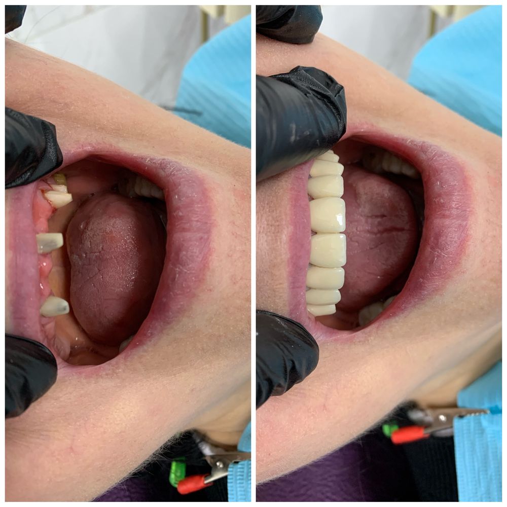 Имплантация зубов. Стоматология