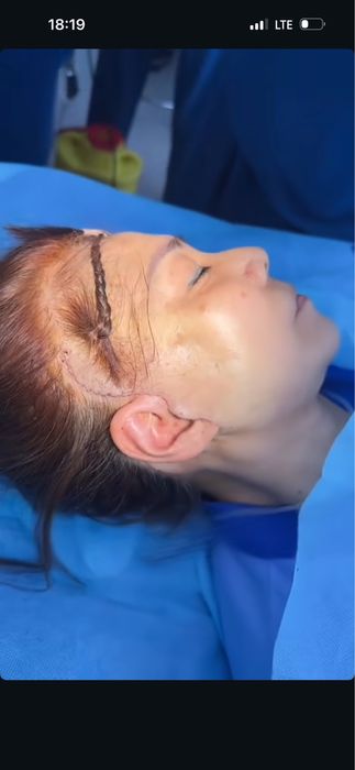 50% chegirmada blefaroplastika