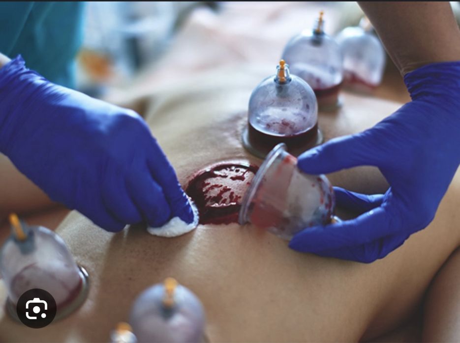 Хиджама.  Қан алу әйелдерге арналған. Кровопускание для женщин.