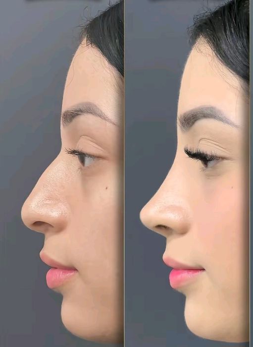 Remodelare nas și buze