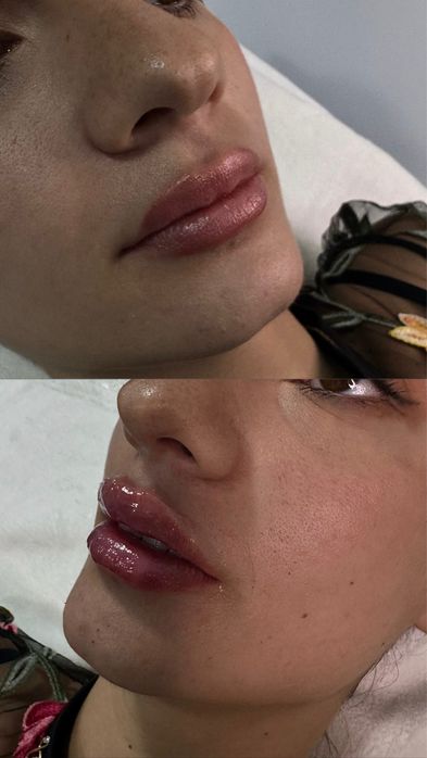 Augmentare buze,umplerea ridurilor si augmentare barbie