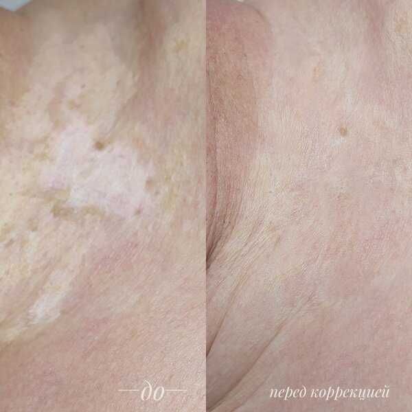 Vitiligo kamuflyaji