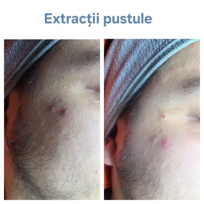 Tratament facial de curățare