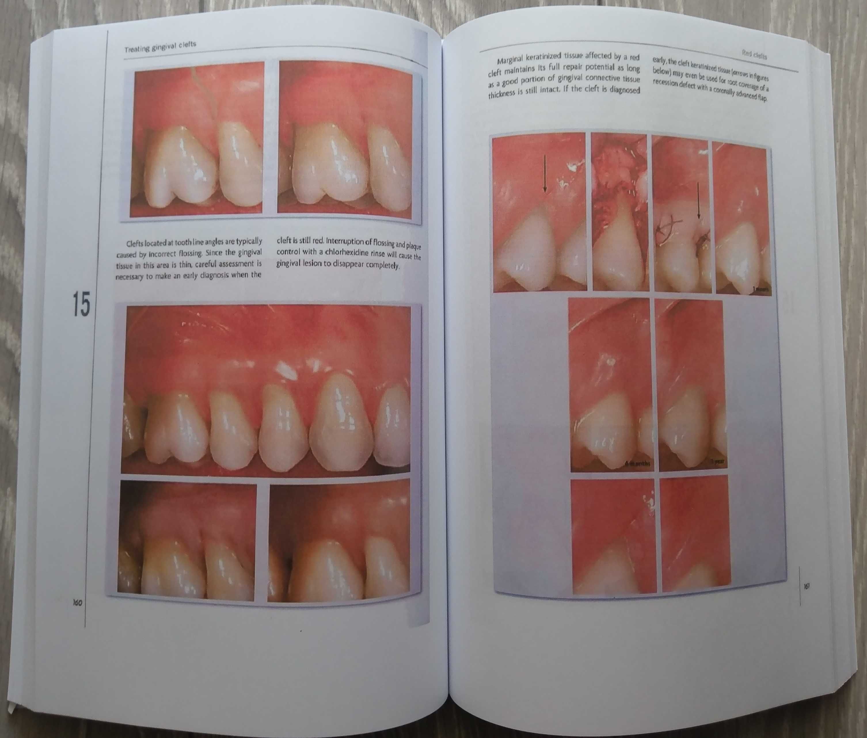 Mucogingival Esthetic Surgery - Giovanni Zucchelli - 1 Edition 2012