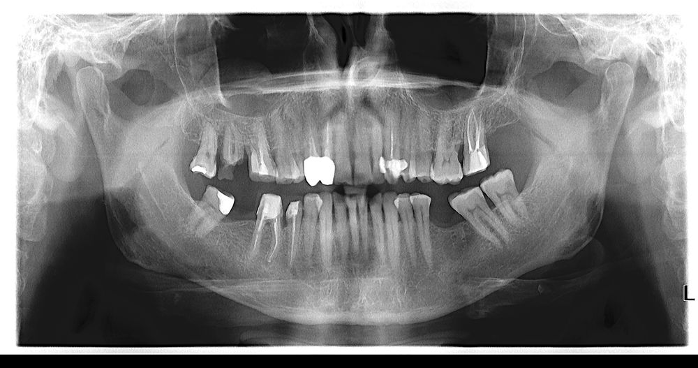 Ortopantomograf Soredex Cranex Novus aparat radiologie dentara