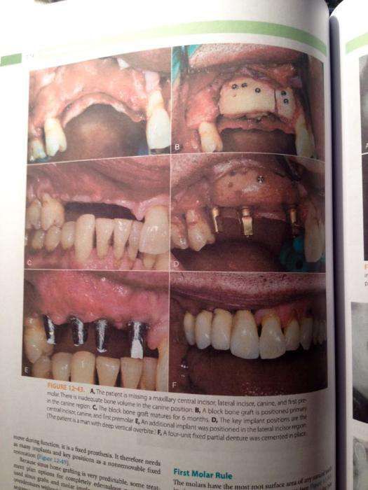 Dental Implant Prosthetics, 2ed (2015)