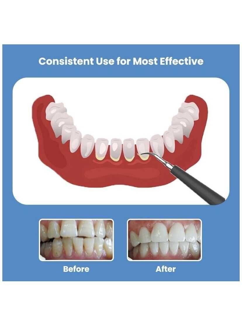 Ултразвуков уред за грижа за зъбите- за премахване на зъбен камък