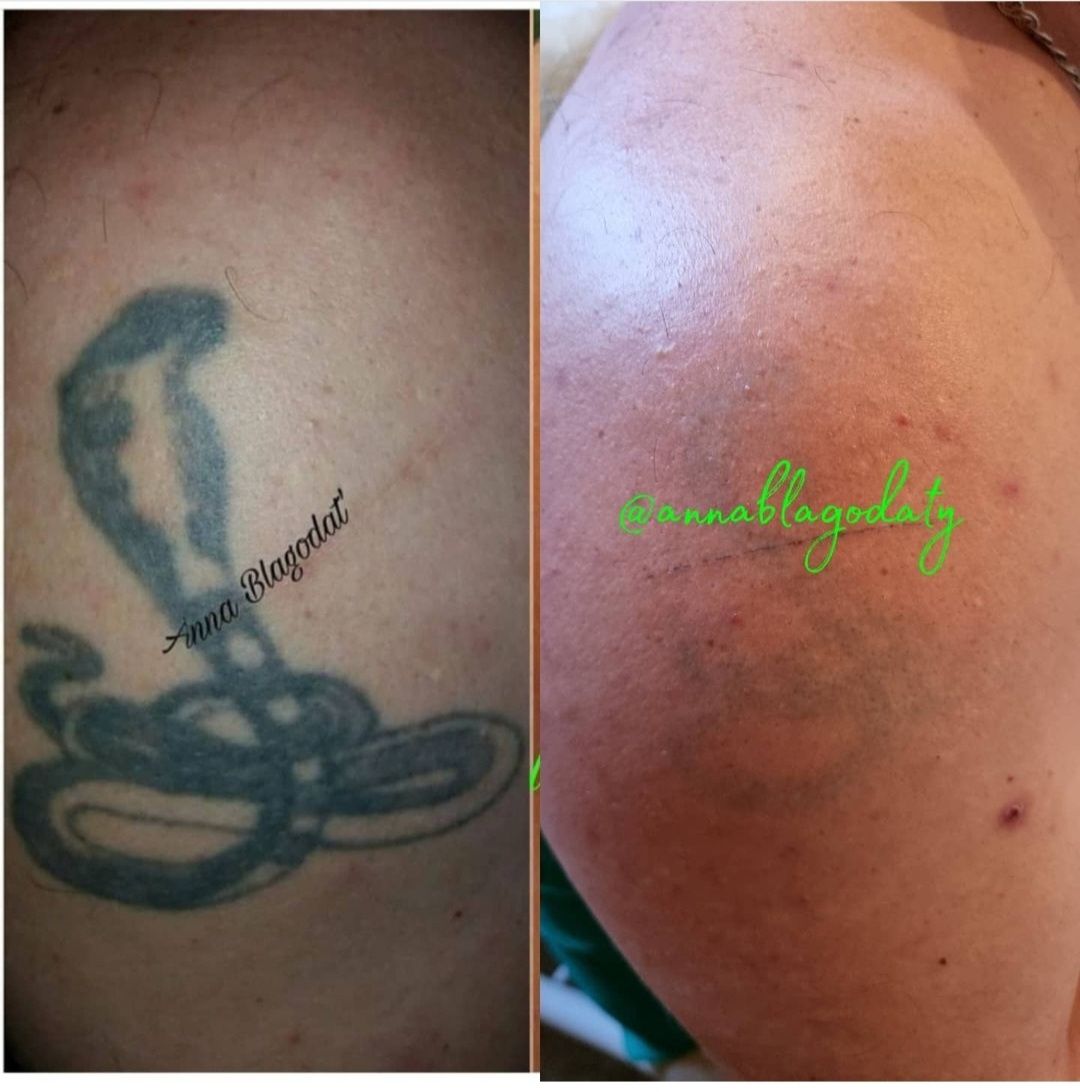 Безопасное лазерное удаление татуажа и татуировок