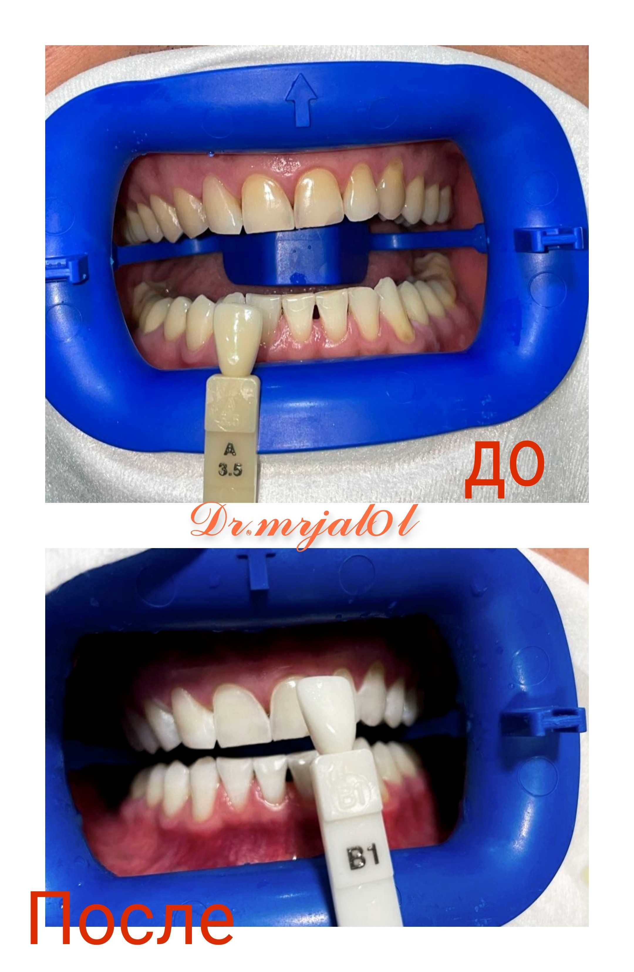 Профессиональная чистка зубов и отбеливание Zoom4