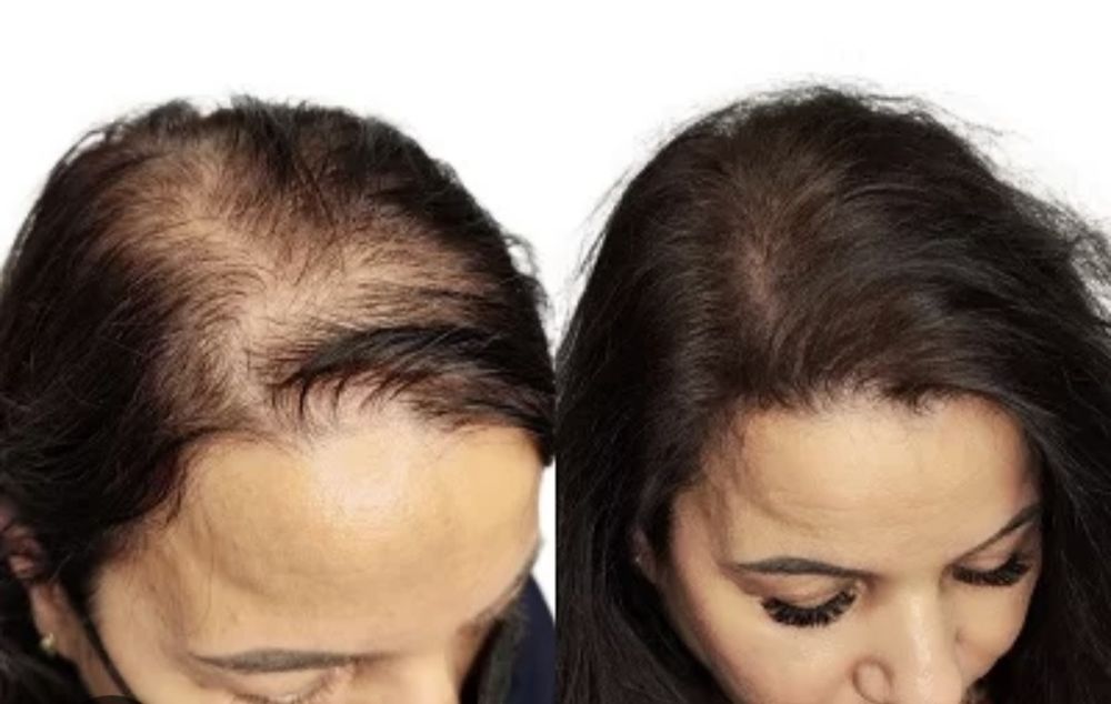 Rinoplastie, mărire buze, micropigmentare