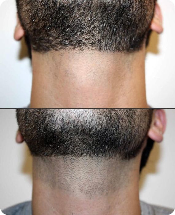 Лаезрная Эпиляция для Мужчин. AFT Удаление волос.