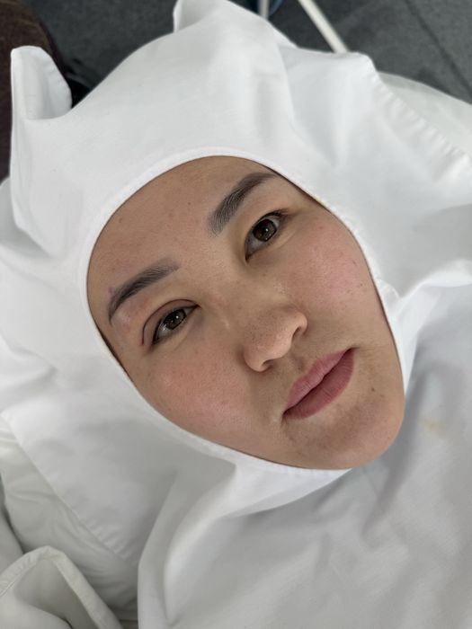 НИТЕВАЯ блефаропластика сангапруи