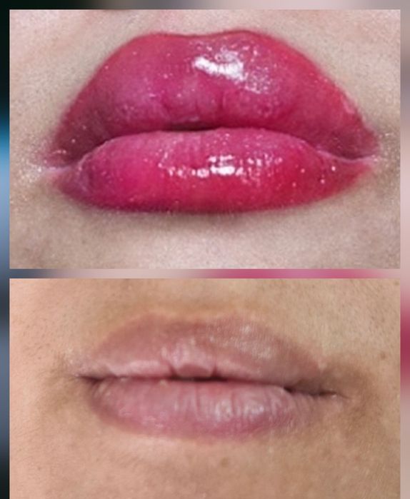 Remodelare nas și buze