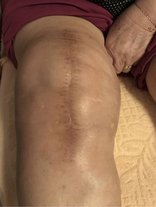 Kinetoterapie la Domiciliu