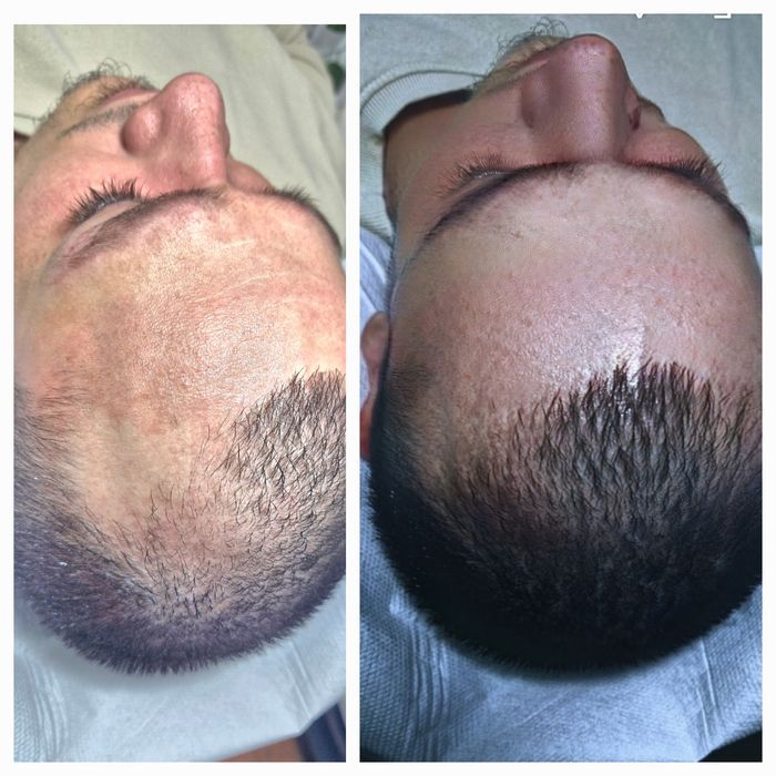 Micropigmentare sprâncene, scalp, rinoplastie