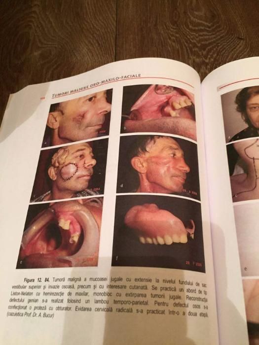 Compendiu de chirurgie oro-maxilo-faciala de Alex. Bucur VOLUMUL 2