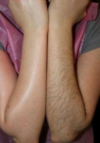 Восковая депиляция и лазерная эпиляция