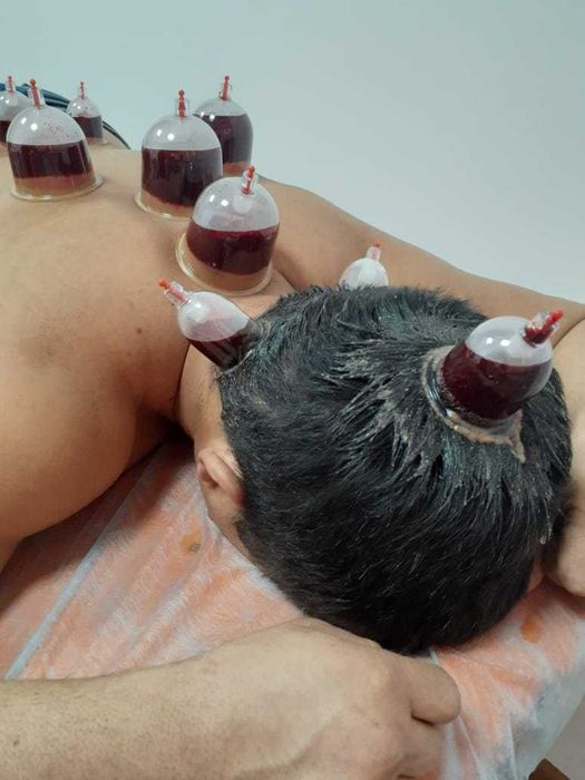 Хиджама с выездом на дом. Круглосуточно. Опытный хаджам.