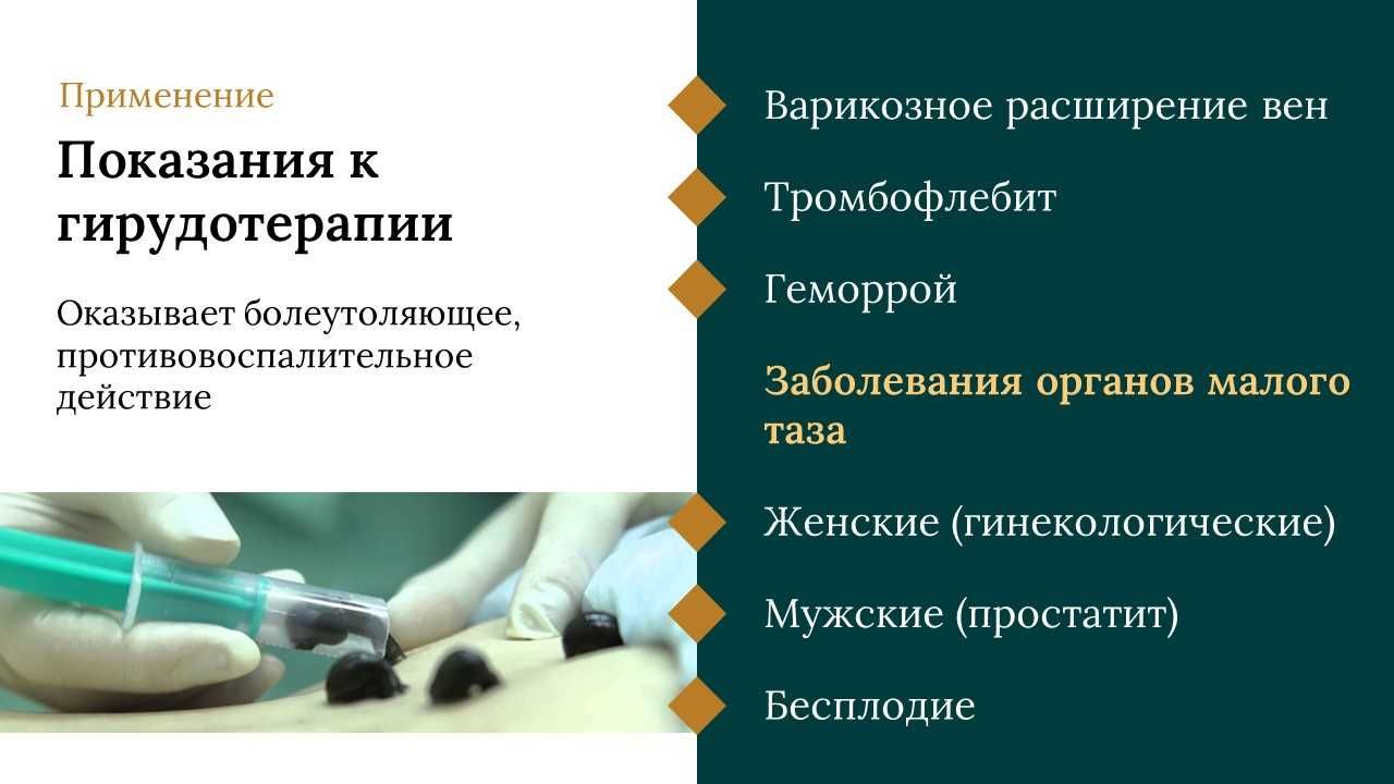 Лечение медицинскими пиявками (гирудотерапия)