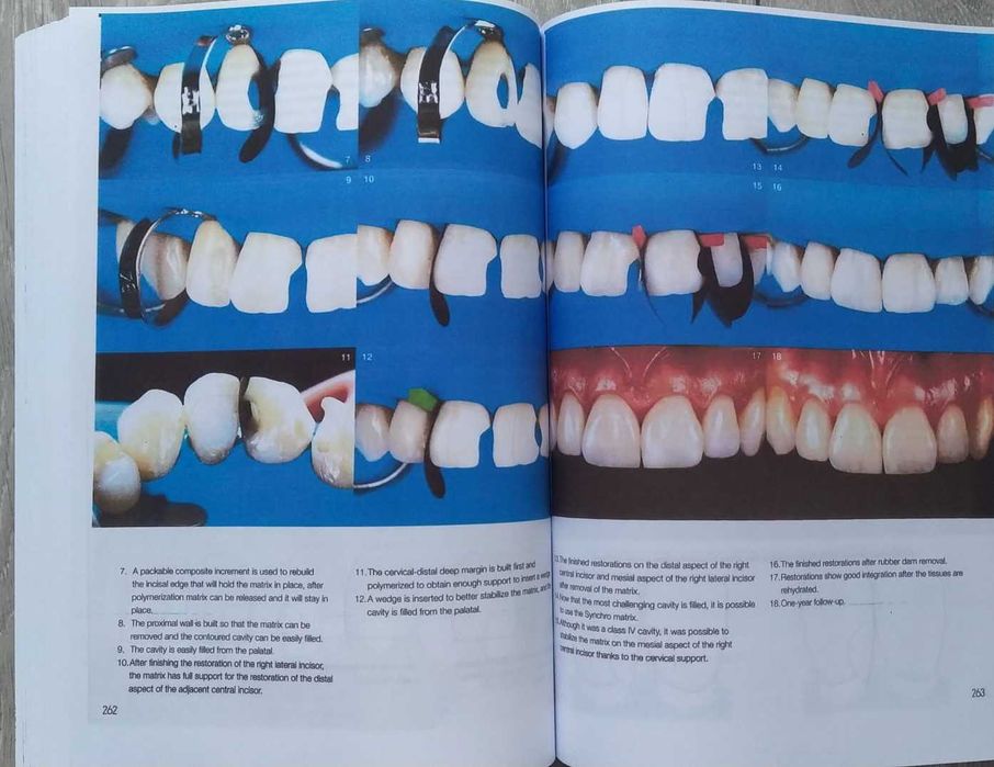 Layers 2 Direct Composites: The Styleitaliano Clinical Secrets - 2022