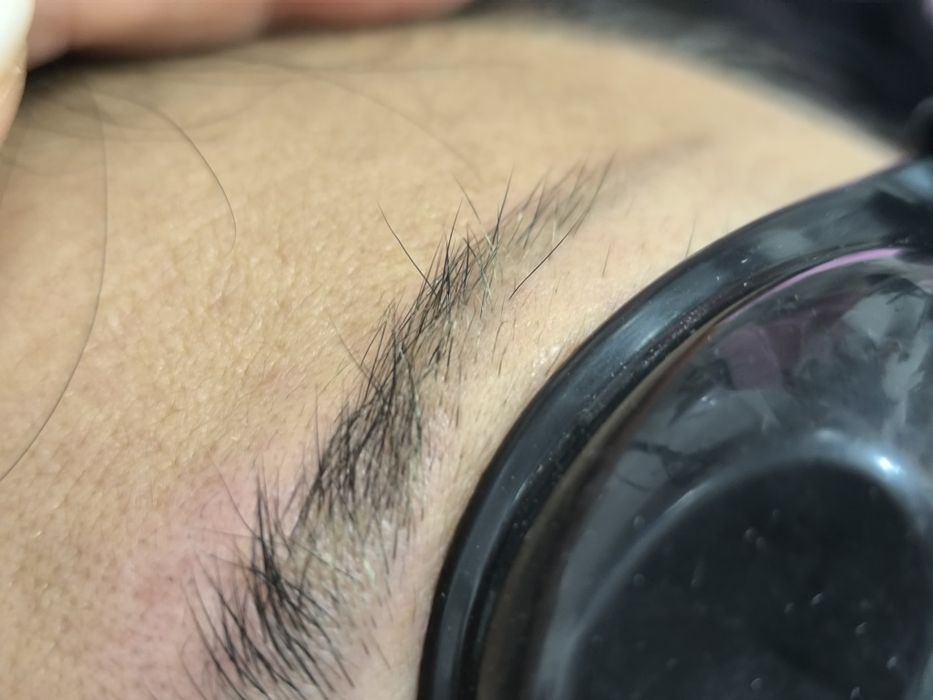 Лазерное удаление татуажа и лазерная эпиляция