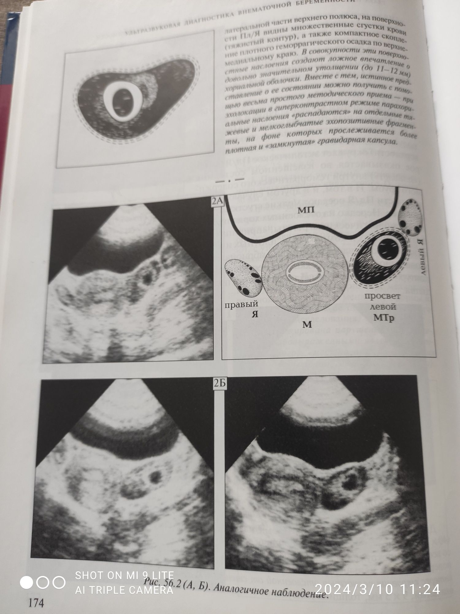 Продам учебник "Ультразвуковая диагностика внематочной беременности"