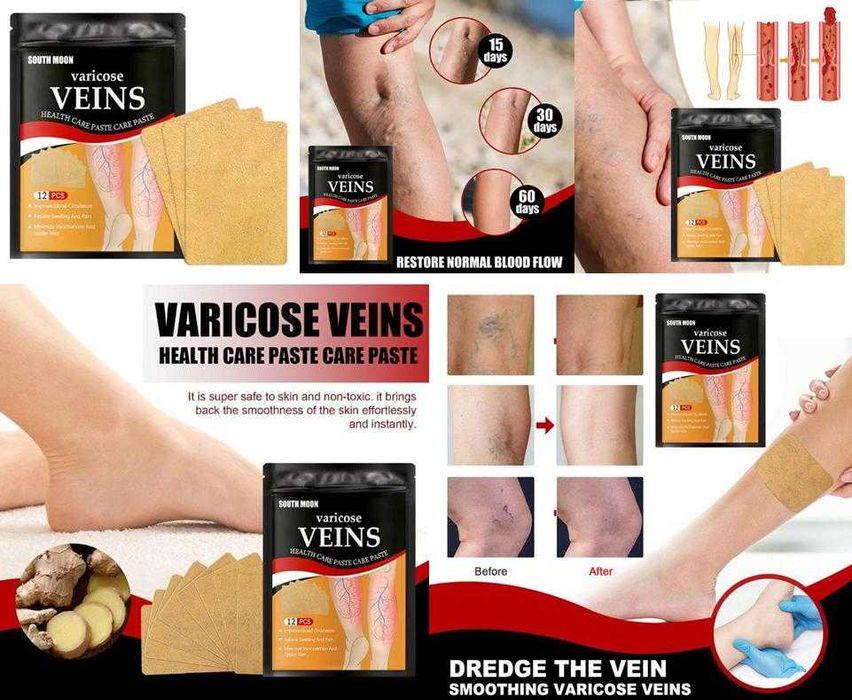 12 Пластири за Разширени Вени Лепенка Лечение Разширени Вени Варикоза