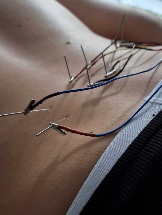 Kinetoterapie & Recuperare | Dry Needling, Tecar, Masaj Terapeutic