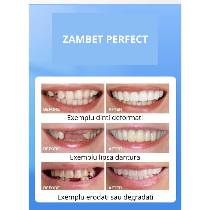 Fațete Dentare Cosmetice SnapSmile – Zâmbet Alb Instant, Reutilizabile