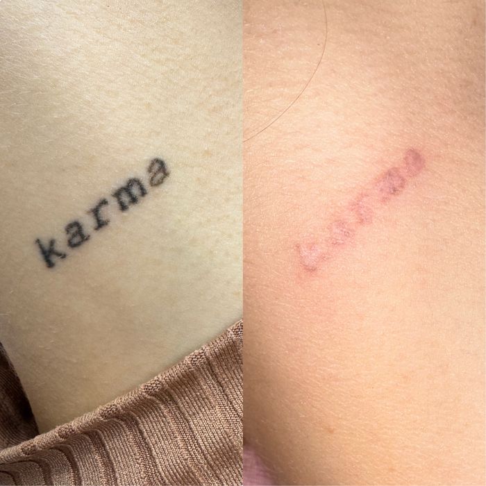 Stergere tatuaje cu laser nd:Yag