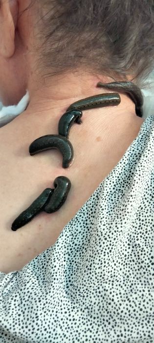 Оздоровления медицинской пиявкой